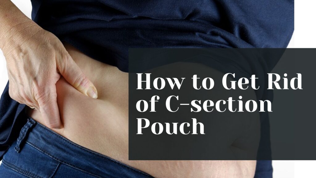 How to Get Rid of C section Pouch