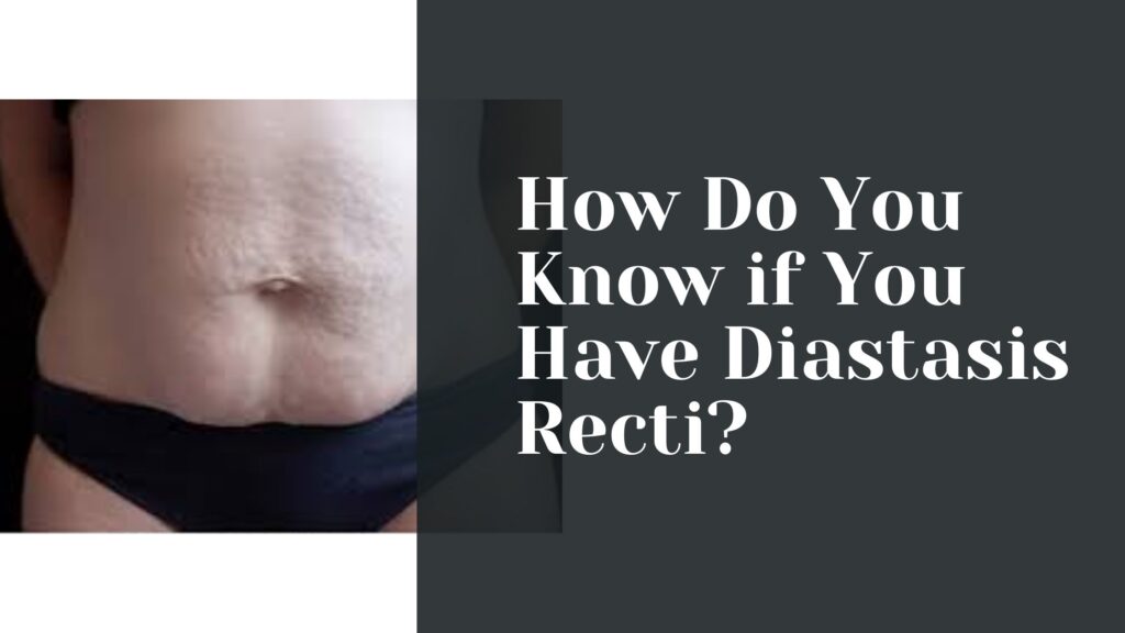 How Do You Know if You Have Diastasis Recti?