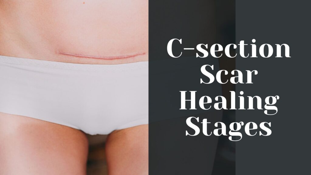 CSection Scar Healing Stages 3 Crucial Steps to Recovery