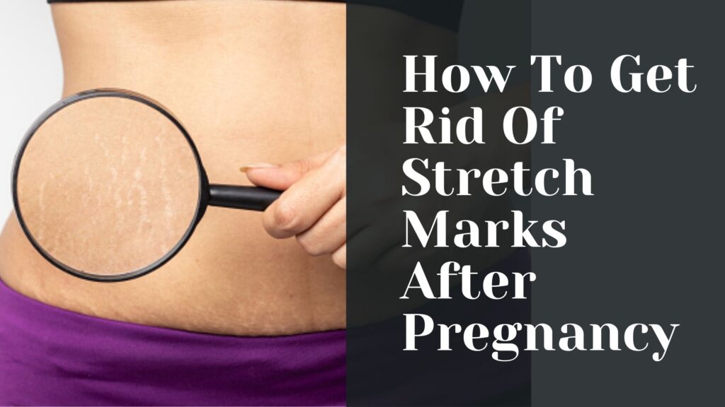 How To Get Rid Of Stretch Marks After Pregnancy